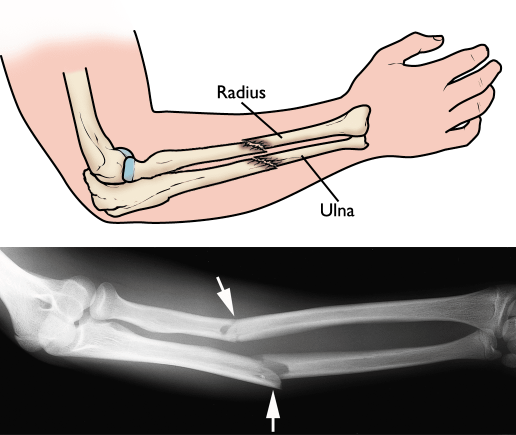 Zlomenina předloktí - rentgen a ilustrace